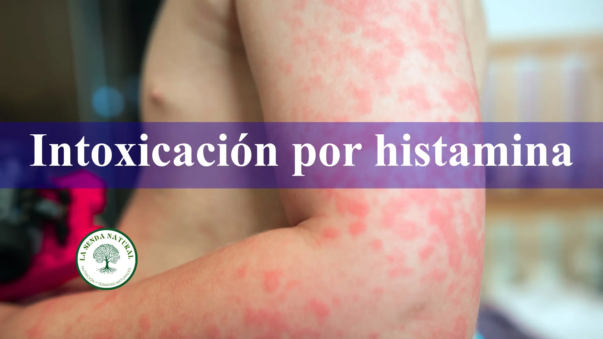 Intoxicación por histamina