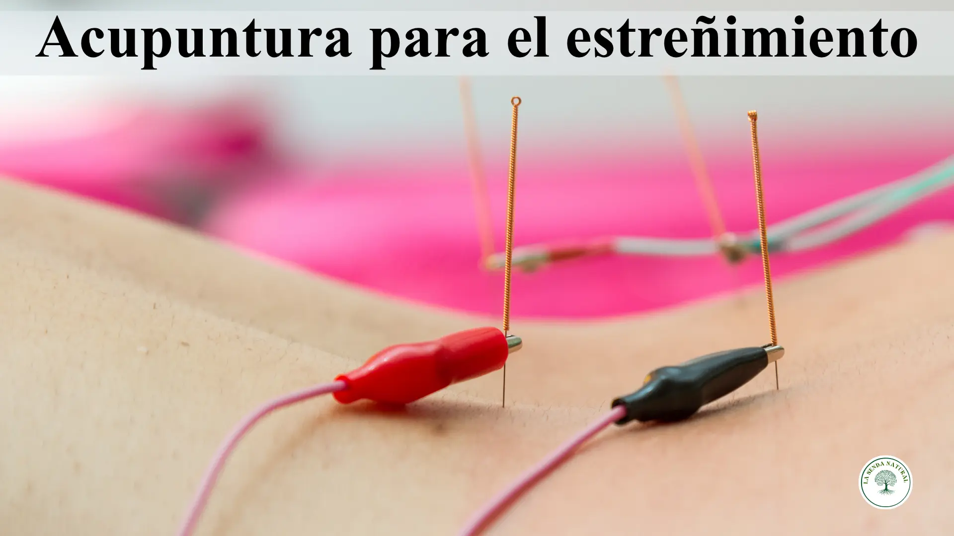 Acupuntura para el estreñimiento