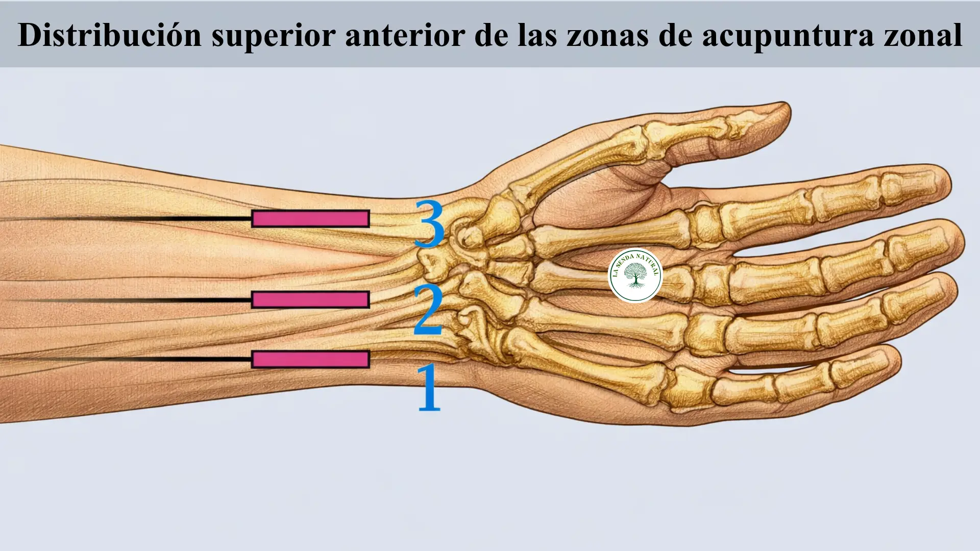 Acupuntura zonal, superior delantera
