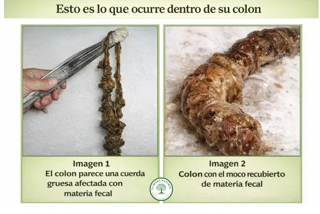 Intestino degradado