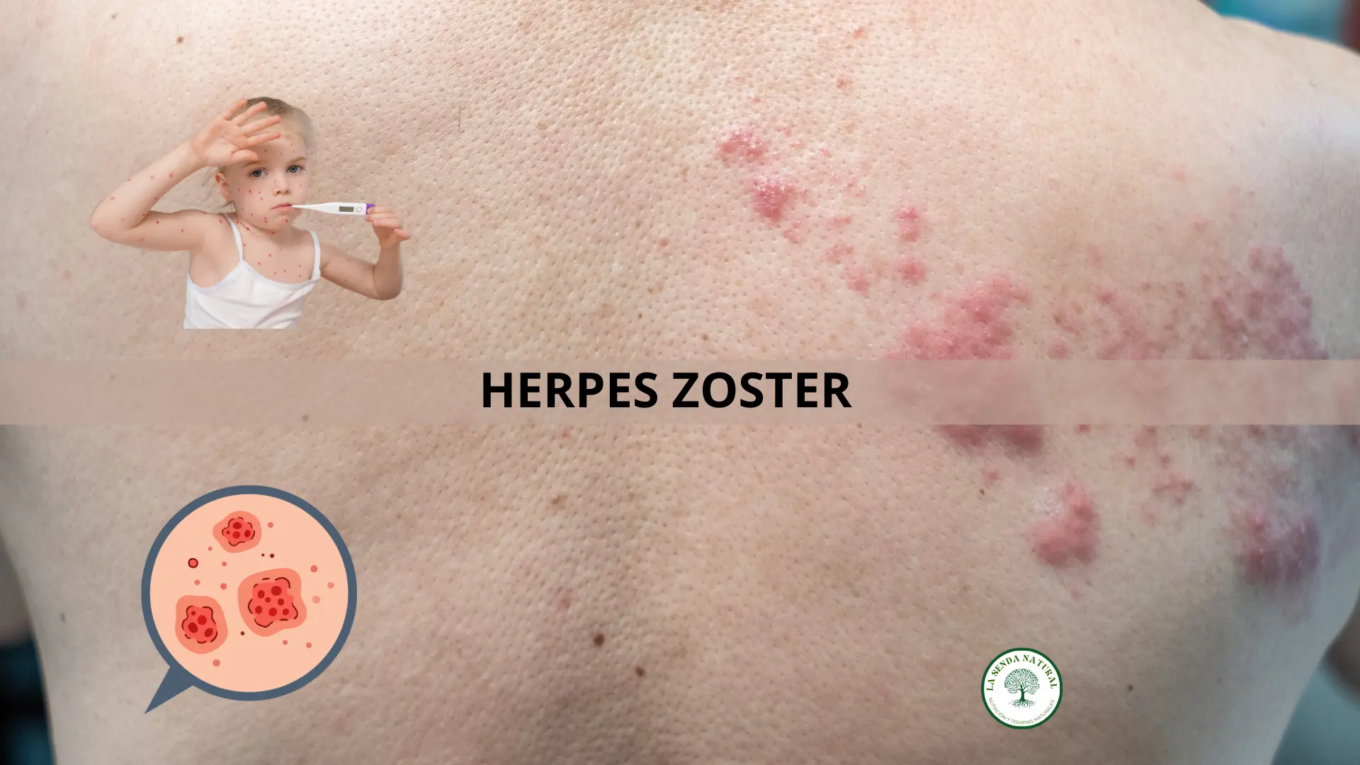 QUÉ ES EL HERPES ZOSTER