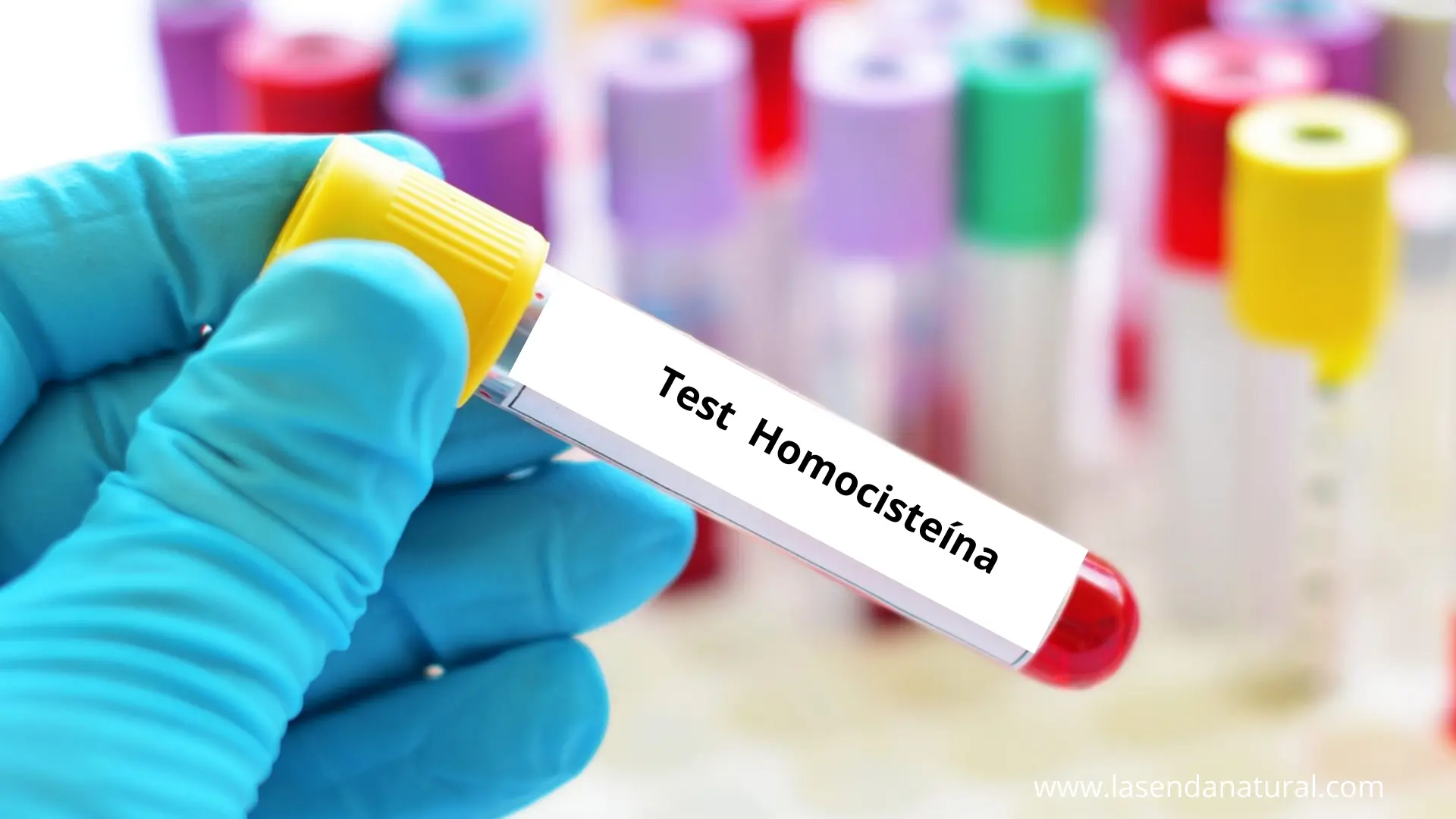 Test de Homocisteína