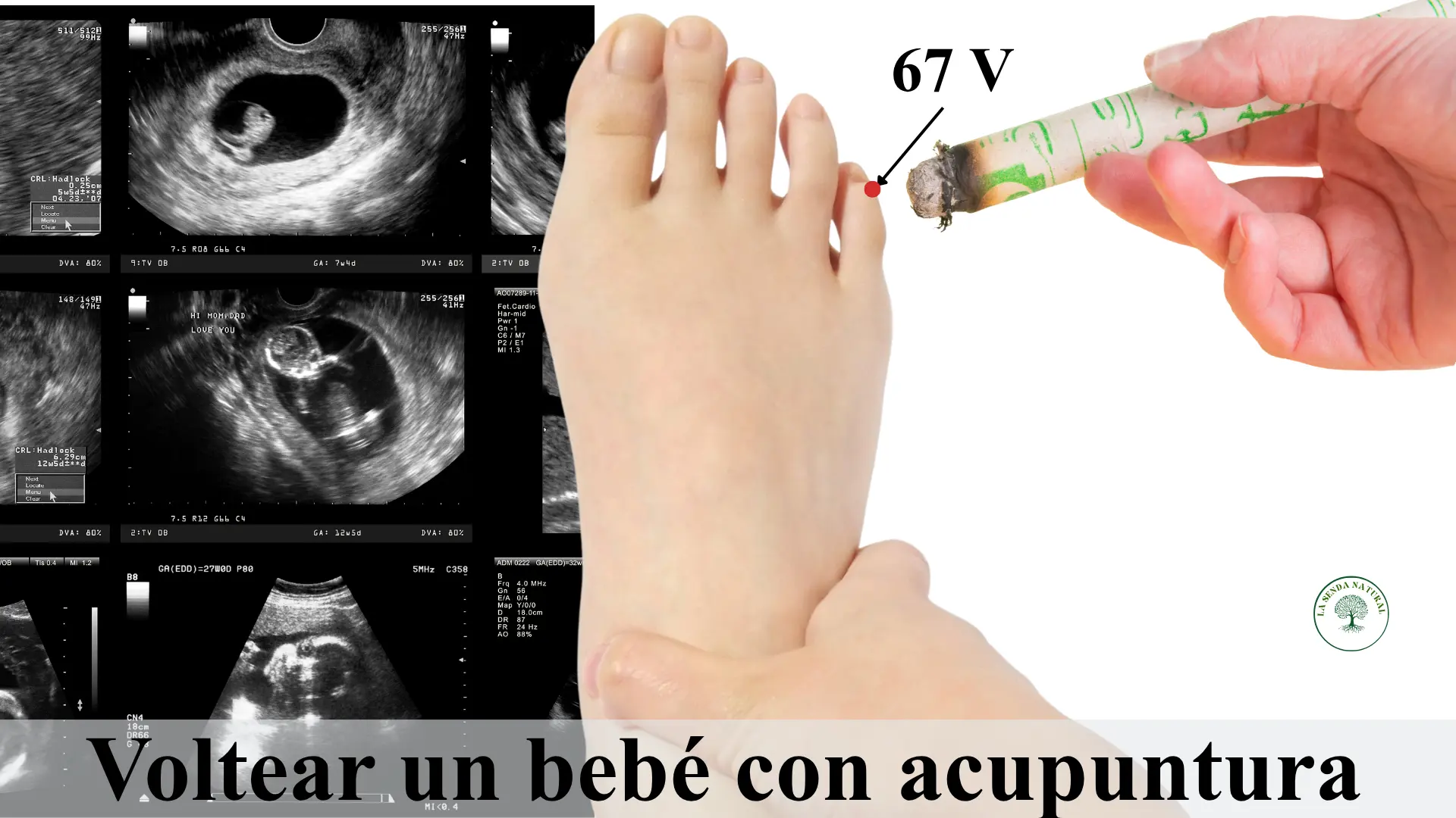 voltear un bebe con acupuntura
